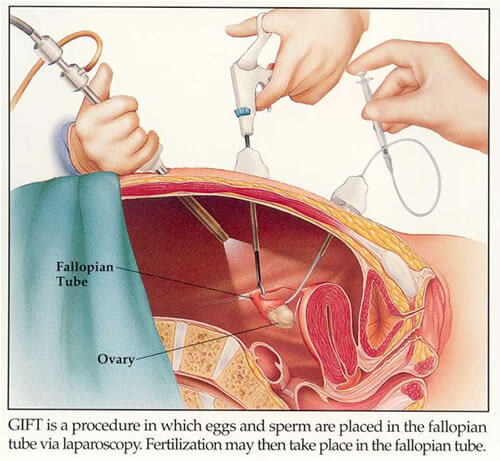 GIFT-fertility-treatment
