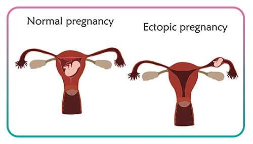 ectopic pregnancy risk