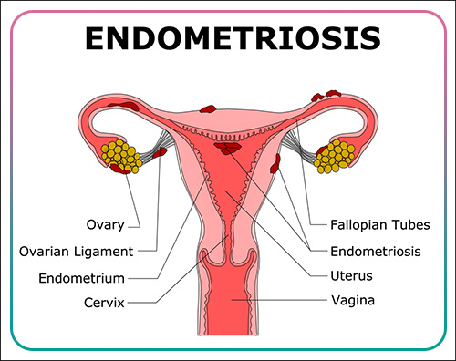 endometriosis treatment in Iran