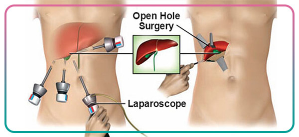 laparoscopy in Iran