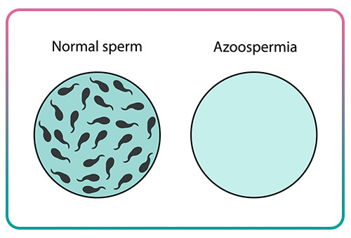 How is azoospermia diagnosed