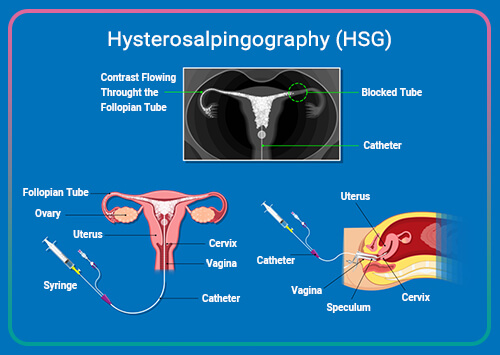 What is hysterosalpingography (HSG)