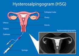hysterosalpingography (HSG)