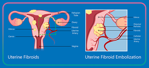 hysteroscopy for fibroids