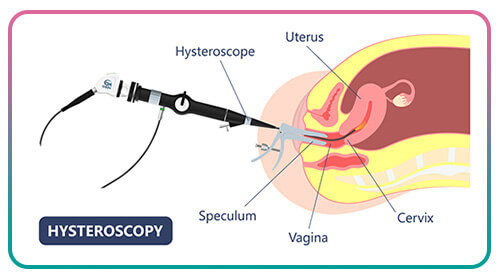 hysteroscopy in Iran