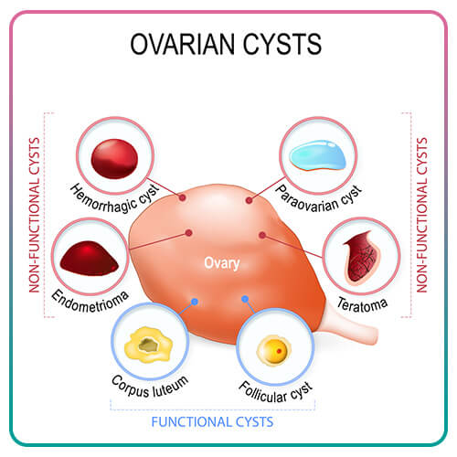 ovarian cysts