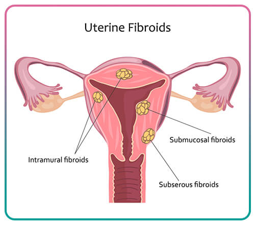 uterine fibroids and infertility