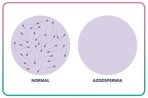 azoospermia and testicular biopsy