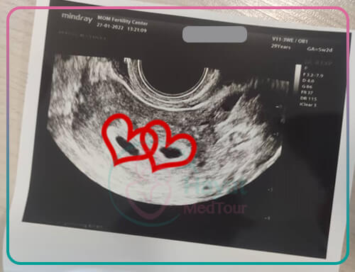 IVF Twin pregnancy