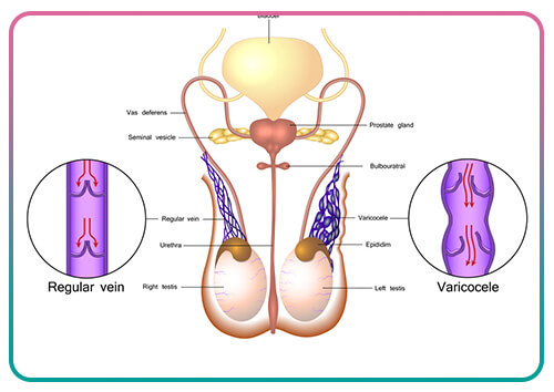 What is a varicocele