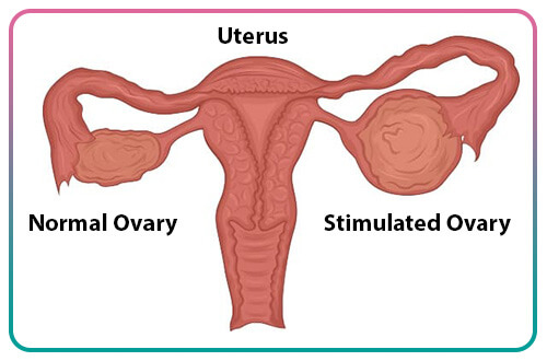 Management of ovarian stimulation for IVF