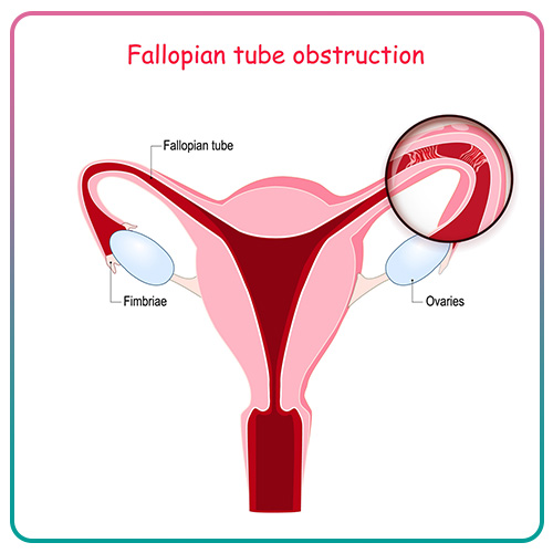 Infertility Problems With the Fallopian