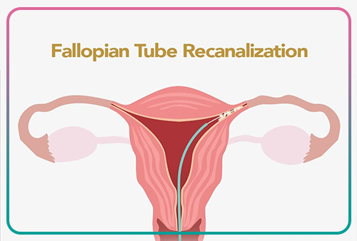 Overcoming fallopian tube blockages with tubal cannulation