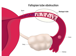 Pregnancy with blocked fallopian tubes