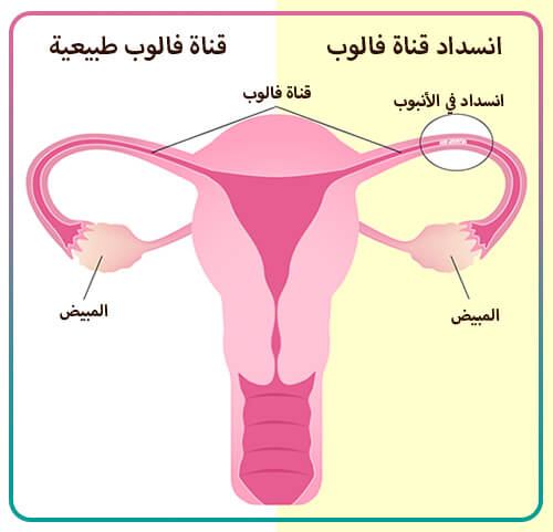 الحمل مع انسداد قناة فالوب