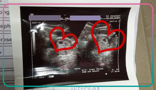 ultrasound of twin pregnancy fetus by successful IVF in Iran