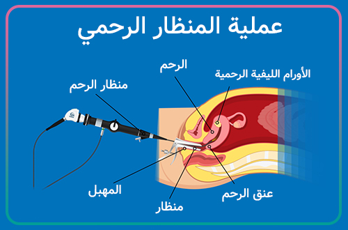 متى نكون بحاجة إلى منظار الرحم؟