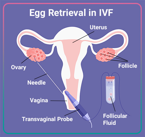 Egg Retrieval IVF Process