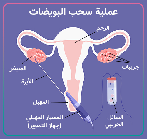 عملية سحب البويضات